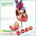 HEART05 (12481) Anatomie du coeur humain grandeur nature en 2 parties avec 4 pièces Coupe transversale de la thrombose, modèles anatomiques&gt; Modèles de coeur